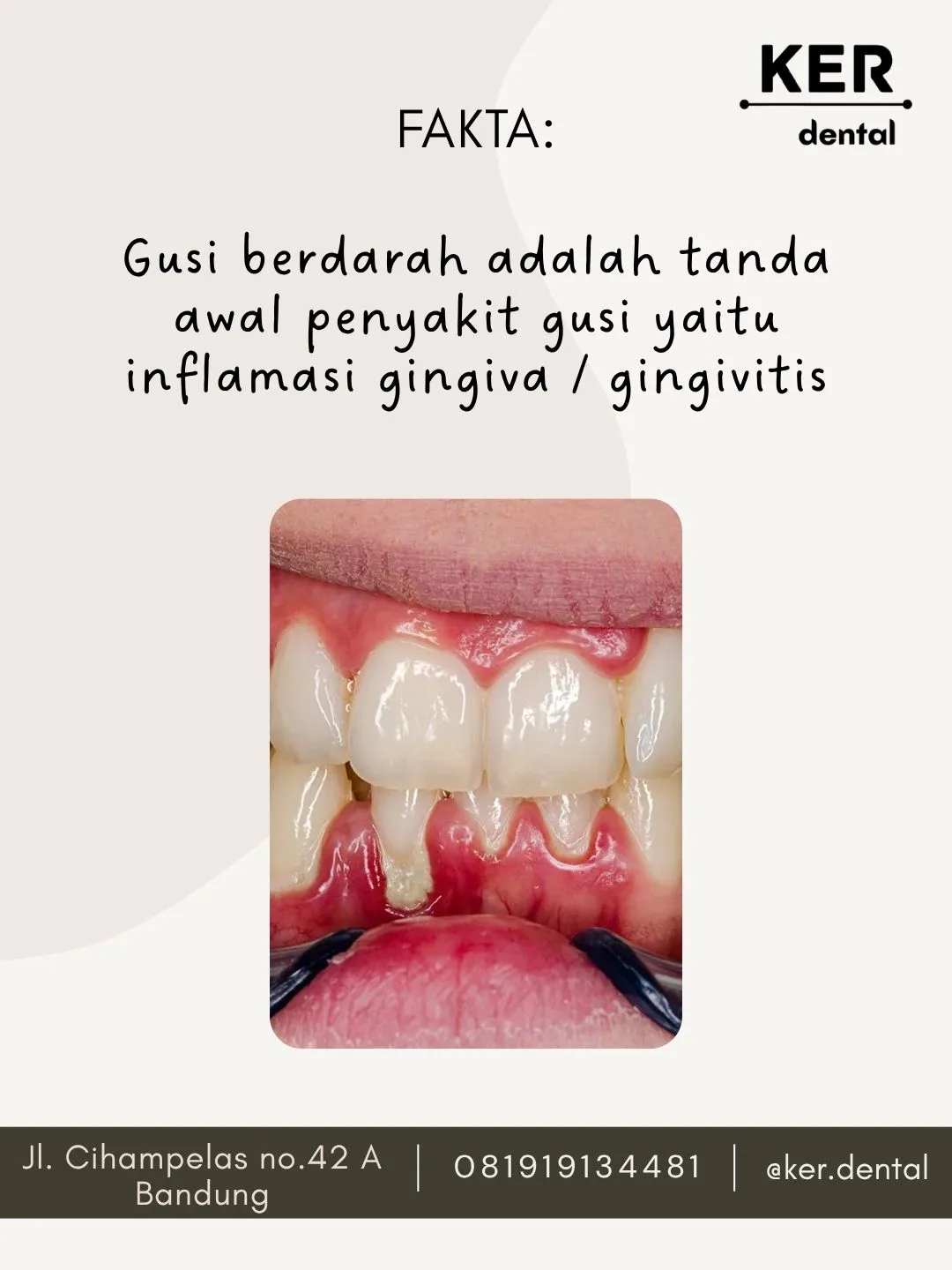 FAKTA : Gusi berdarah adalah tanda awal penyakit gusi yaitu inflamasi gingiva / gingivitis